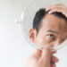 alopecia