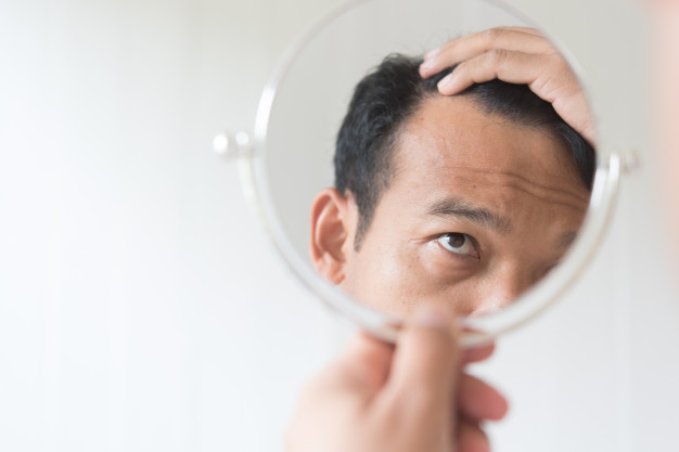 alopecia