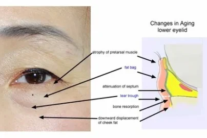 Anatomy of eye bag