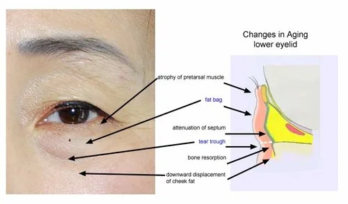Anatomy of eye bag