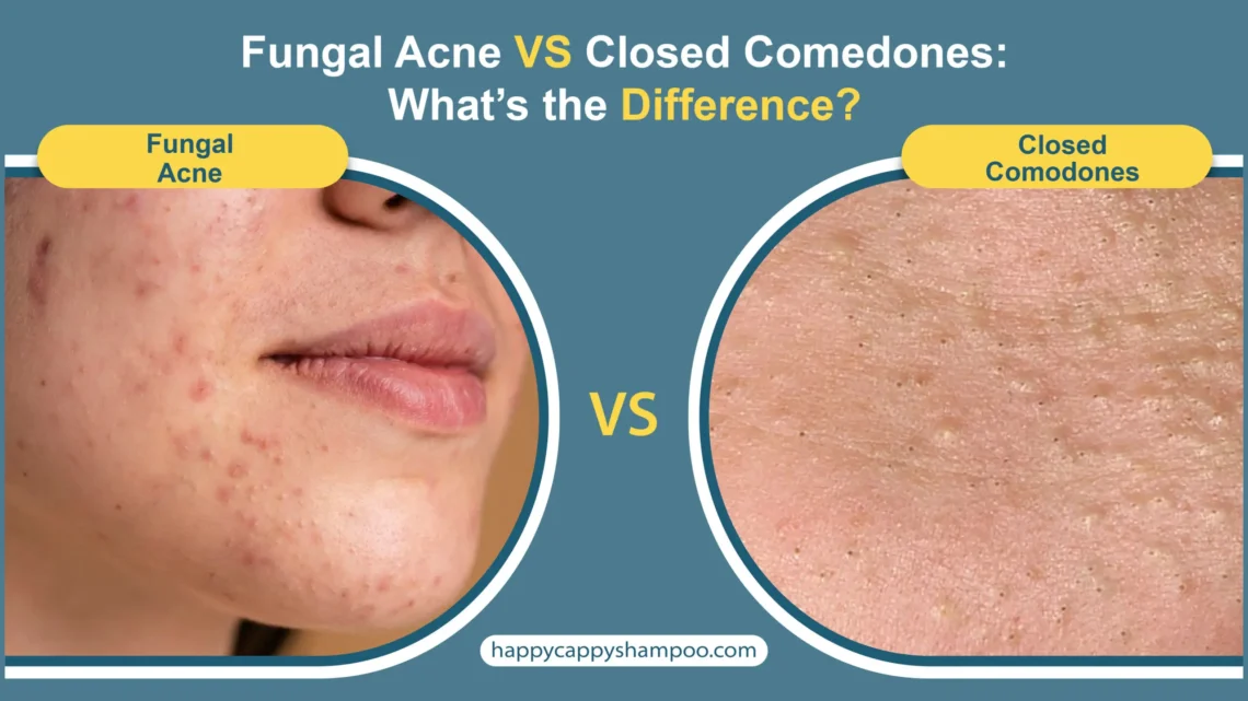 Fungal Acne vs Closed Comedones scaled.jpg