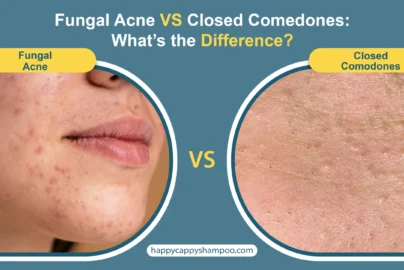 Fungal Acne vs Closed Comedones scaled.jpg