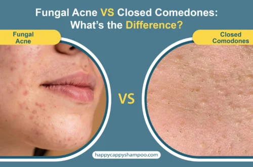 Fungal Acne vs Closed Comedones scaled.jpg
