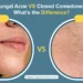 Fungal Acne vs Closed Comedones scaled.jpg