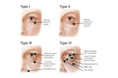 periorbital eye aging types 12ce7a8f c5e6 4707 bea9 3076c227d97c 800x