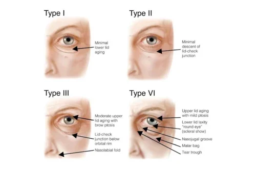 periorbital eye aging types 12ce7a8f c5e6 4707 bea9 3076c227d97c 800x