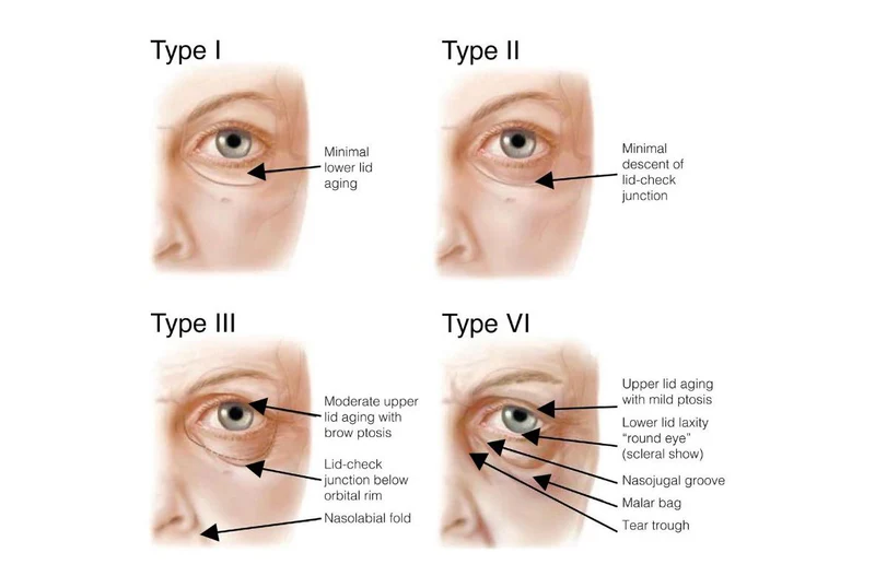 periorbital eye aging types 12ce7a8f c5e6 4707 bea9