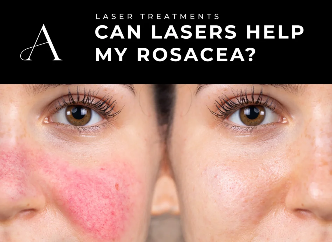 Blog Image Can a Laser Treatment Help My Rosacea scaled 1