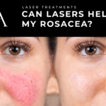Blog Image Can a Laser Treatment Help My Rosacea scaled 1