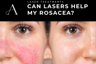 Blog Image Can a Laser Treatment Help My Rosacea scaled 1