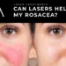 Blog Image Can a Laser Treatment Help My Rosacea scaled 1