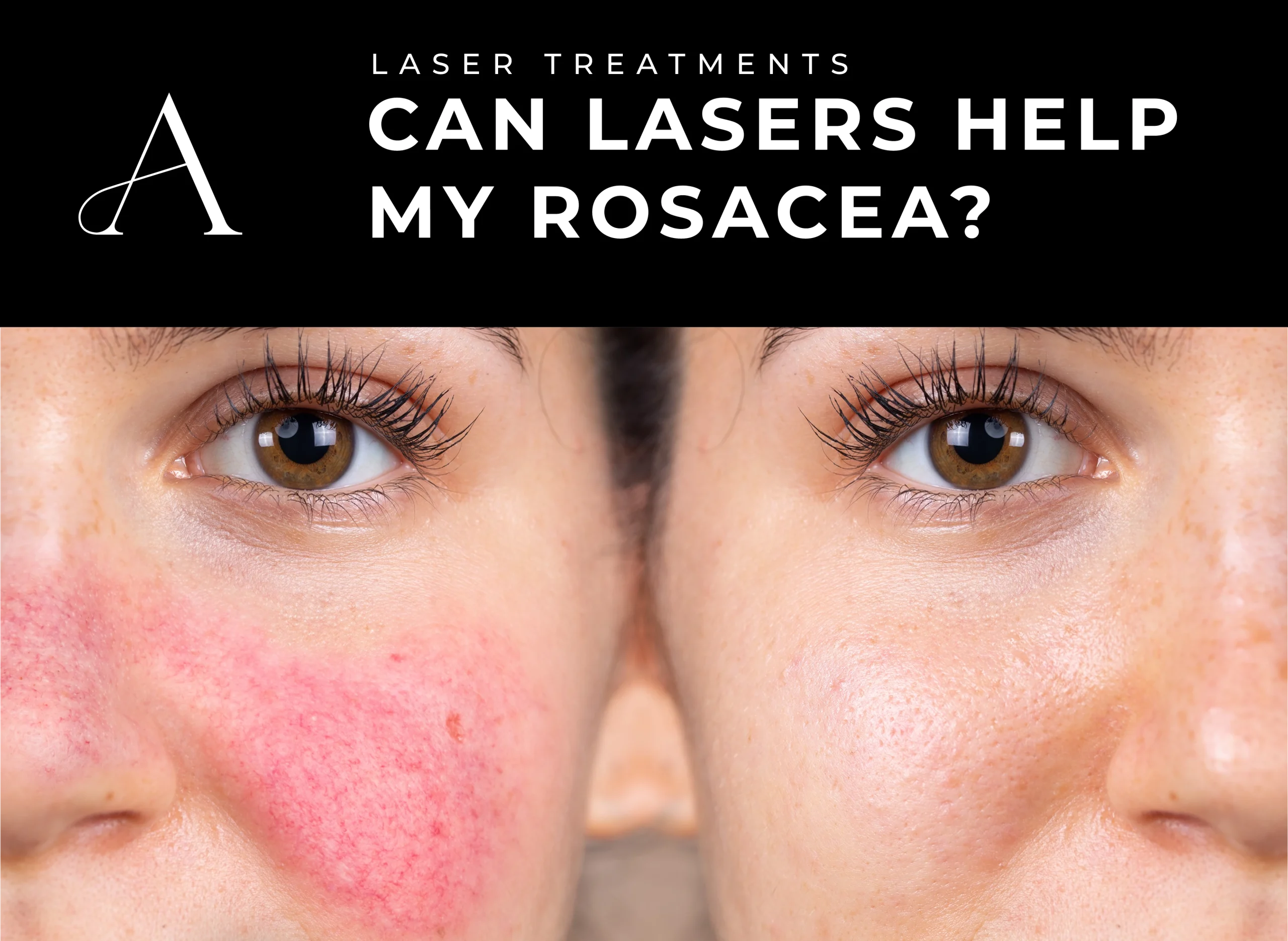 Blog Image Can a Laser Treatment Help My Rosacea scaled 1
