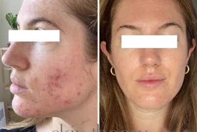 Lymphaticdrainageforacne